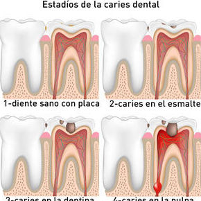 Endodoncia