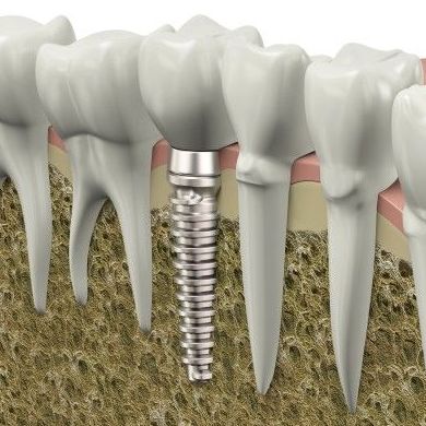 Implantes dentales