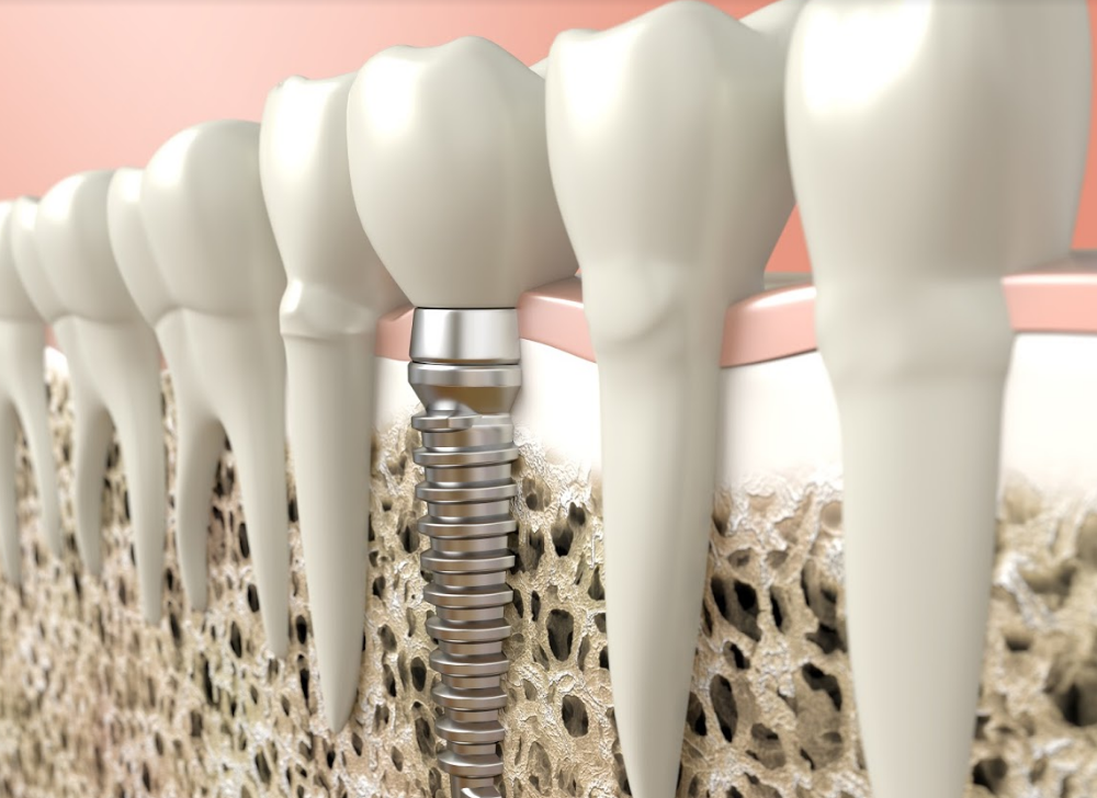 Implantes dentales