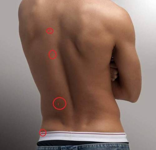 Contracturas de espalda