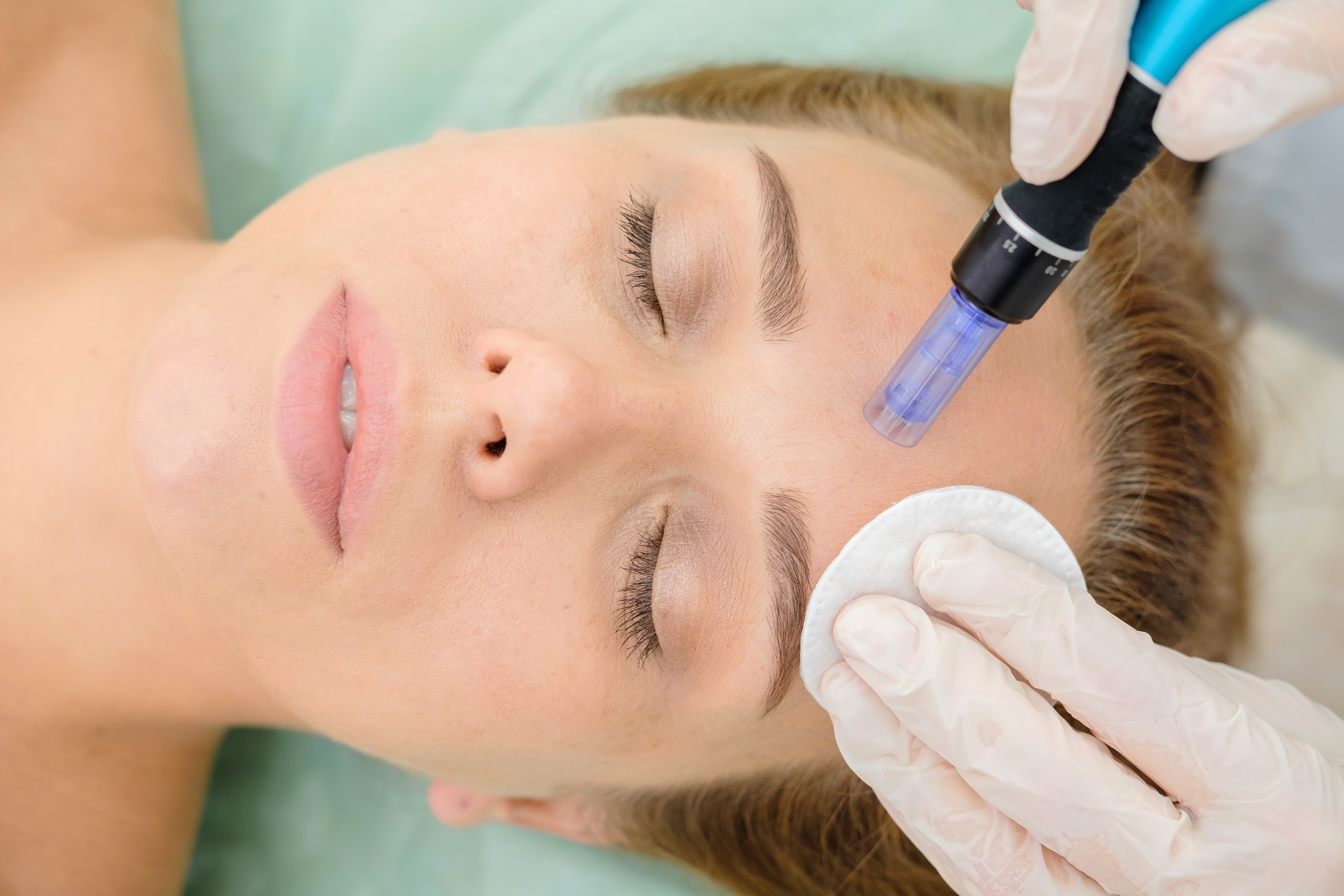 Exosomas + Dermapen