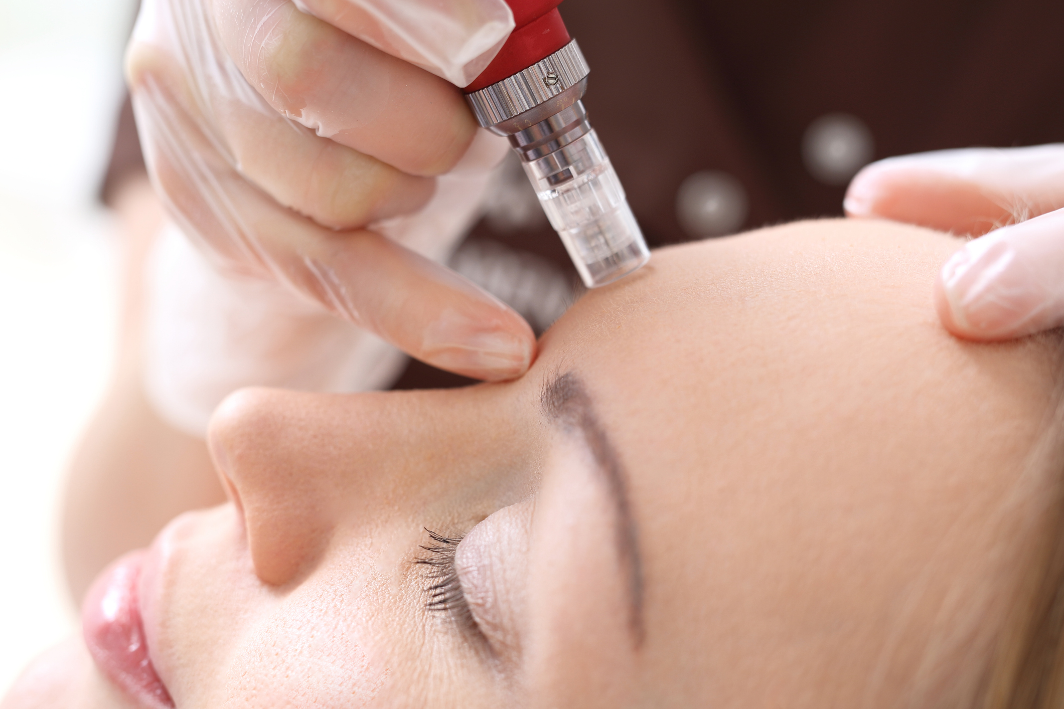 Vitaminas faciales + Dermapen
