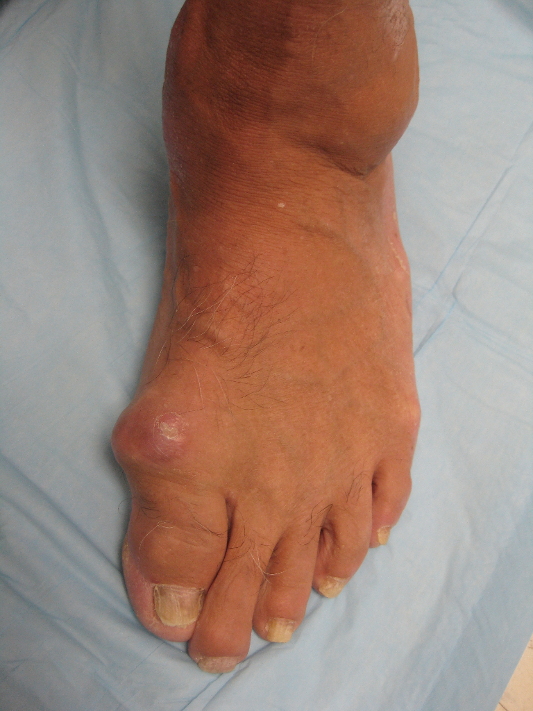 Hallux Rigidus
