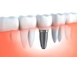 Implantes dentales