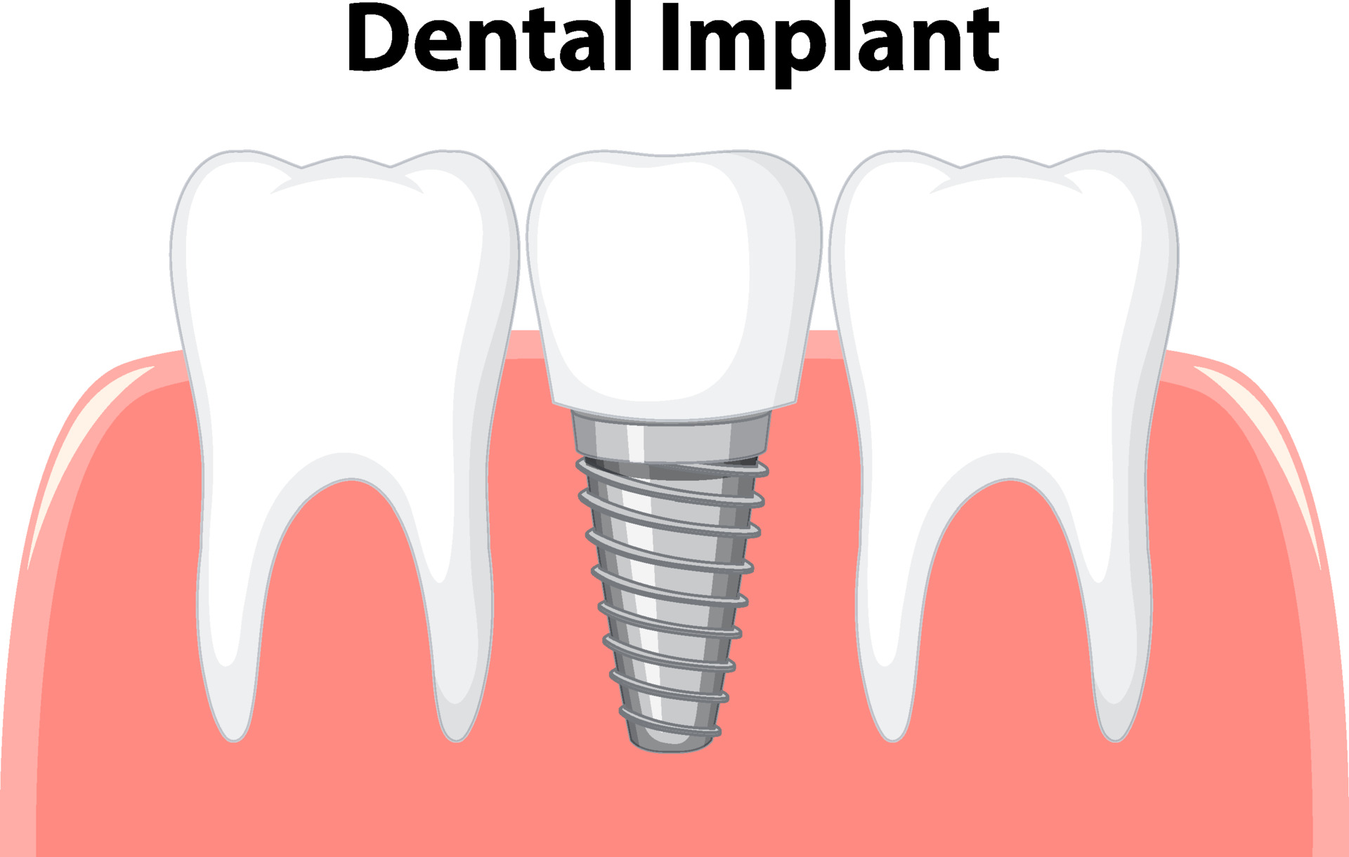 Implantes dentales