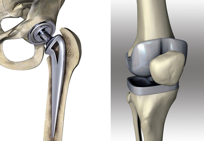 Prótesis de cadera y rodilla