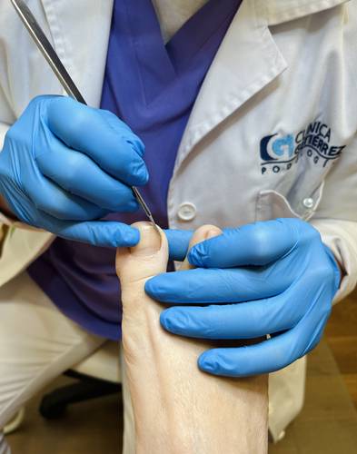 Tratamiento de Uñas Encarnadas