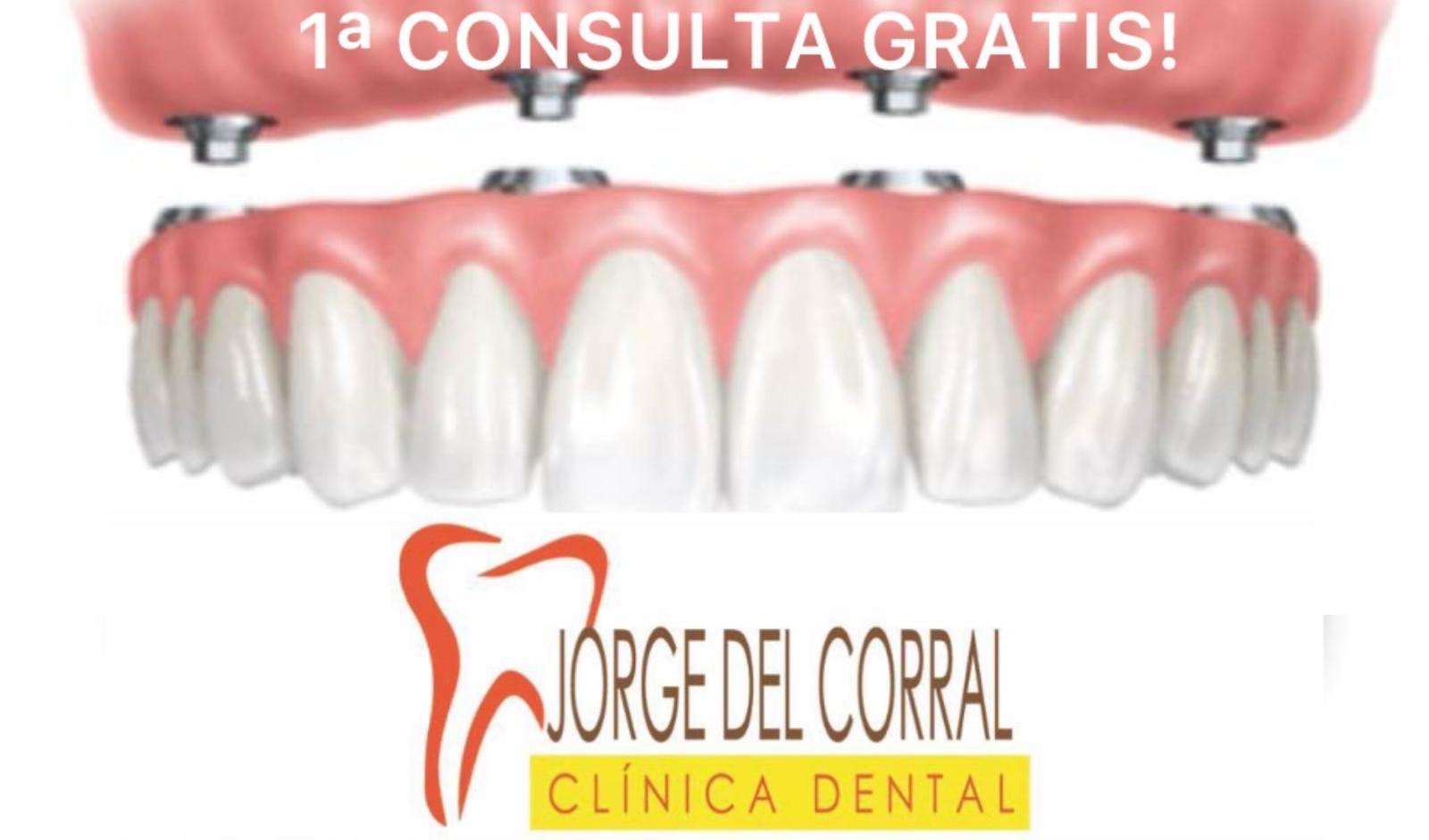 -20% EN IMPLANTES DENTALES, PRÓTESIS FIJA Y -20% CARILLAS DENTALES ESTÉTICAS.