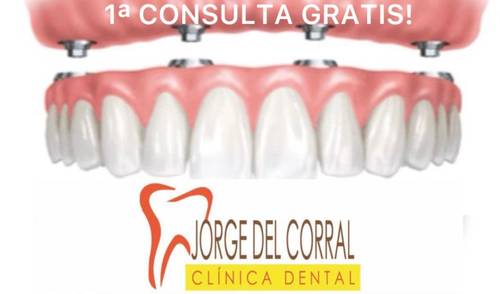 -20% EN IMPLANTES DENTALES, PRÓTESIS FIJA Y -20% CARILLAS DENTALES ESTÉTICAS.