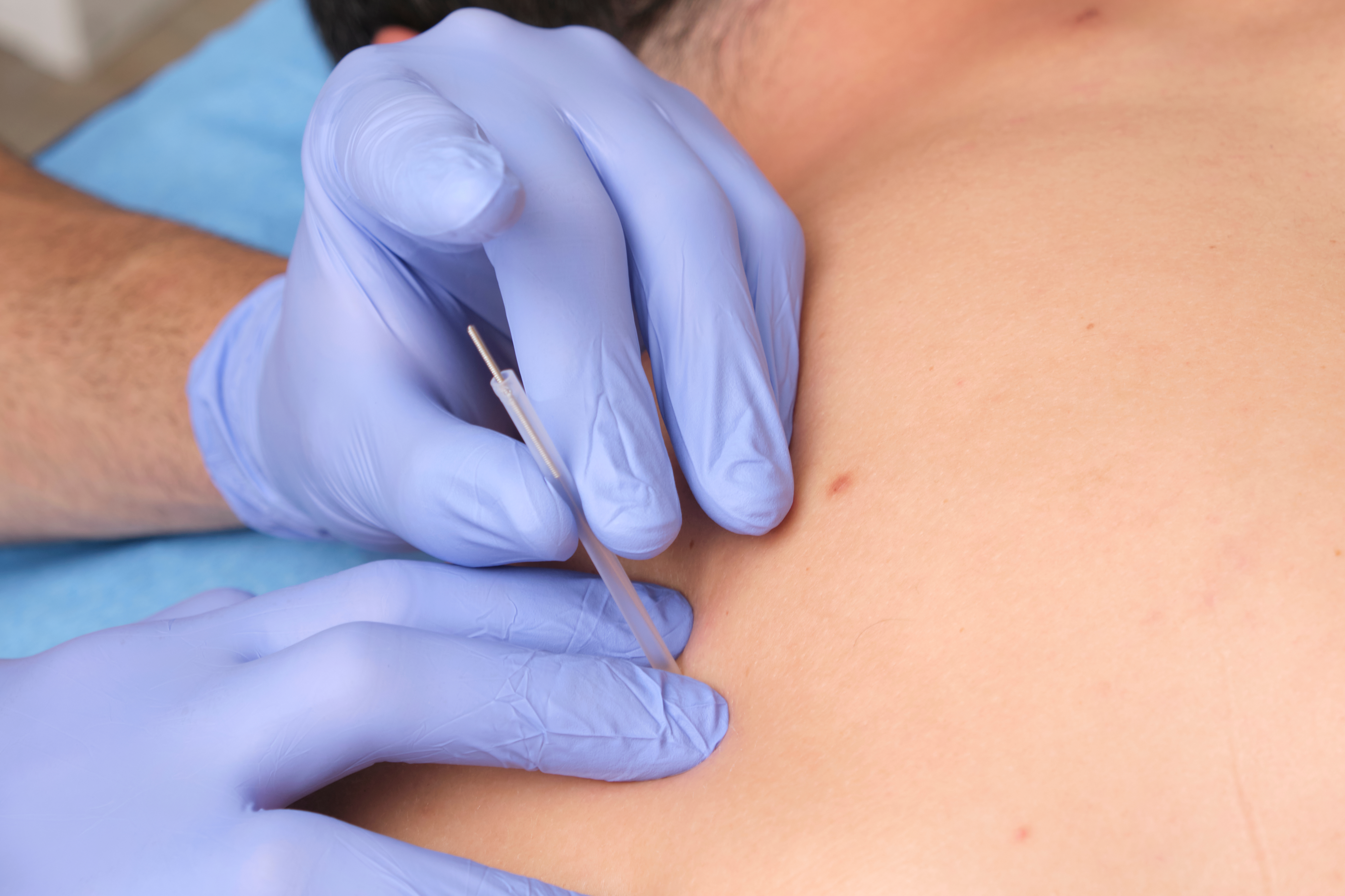 Fisioterapia invasiva