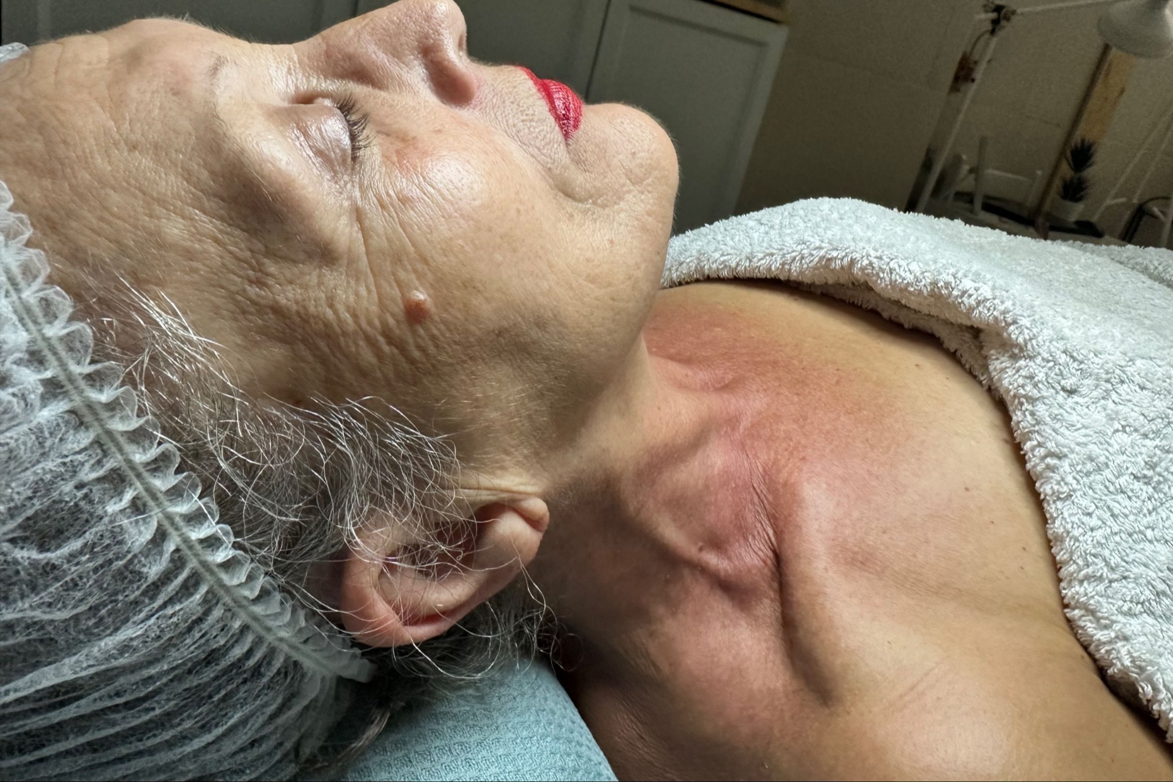 Hidrodermoabrasión higiene facial profunda
