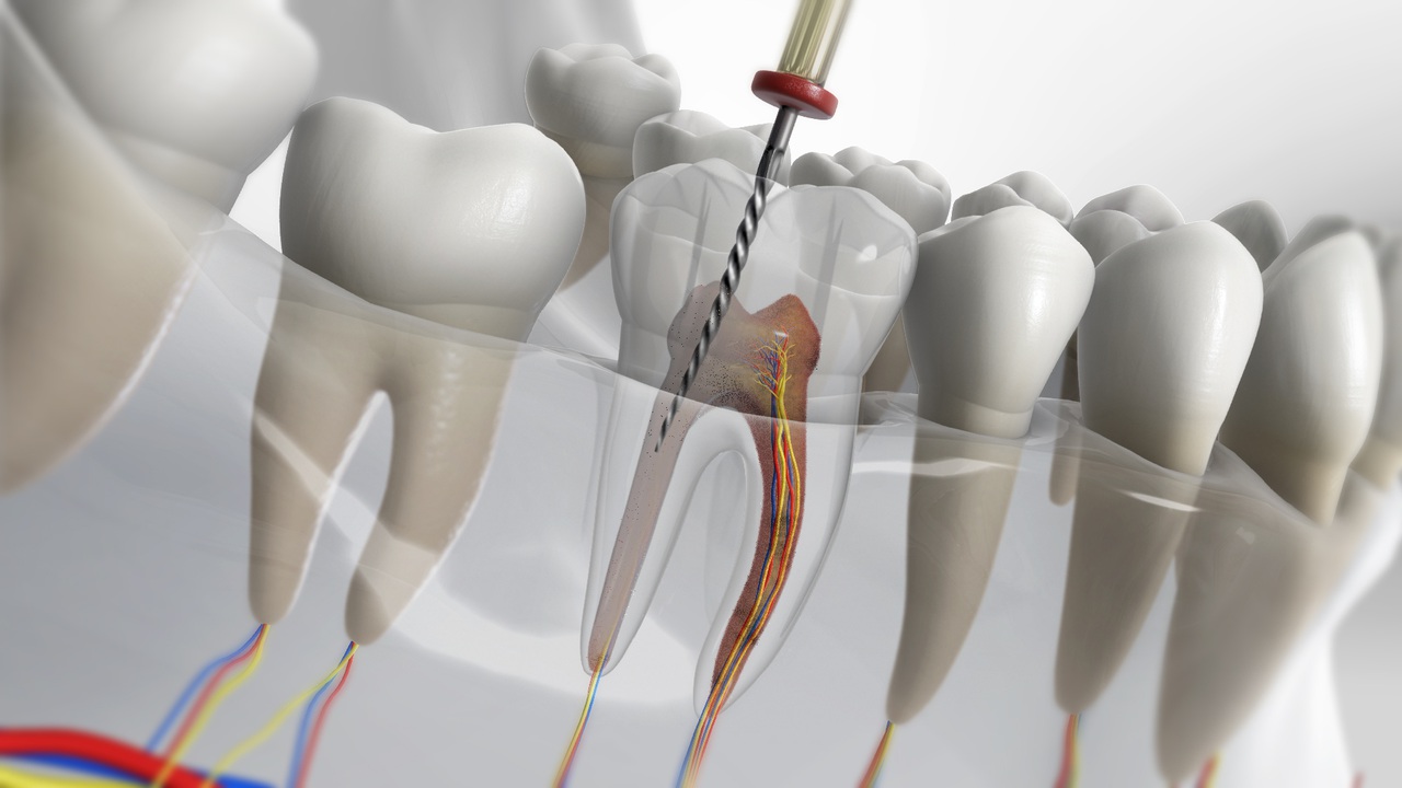 Endodoncia