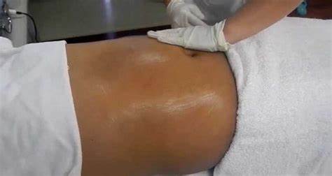 Abdominoplastia
