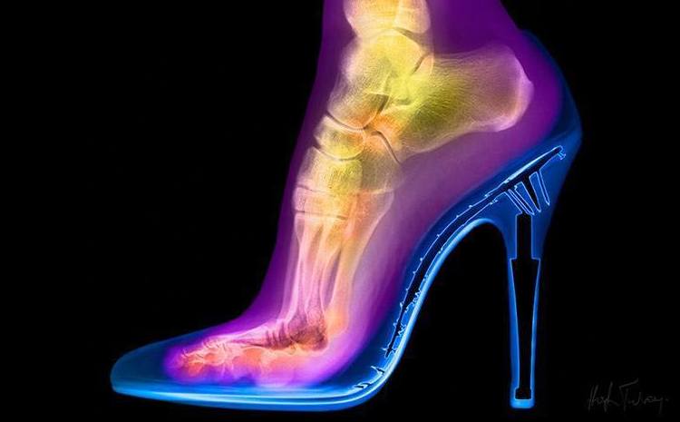 Evidencia de cómo sufre el pie utilizando tacones altos