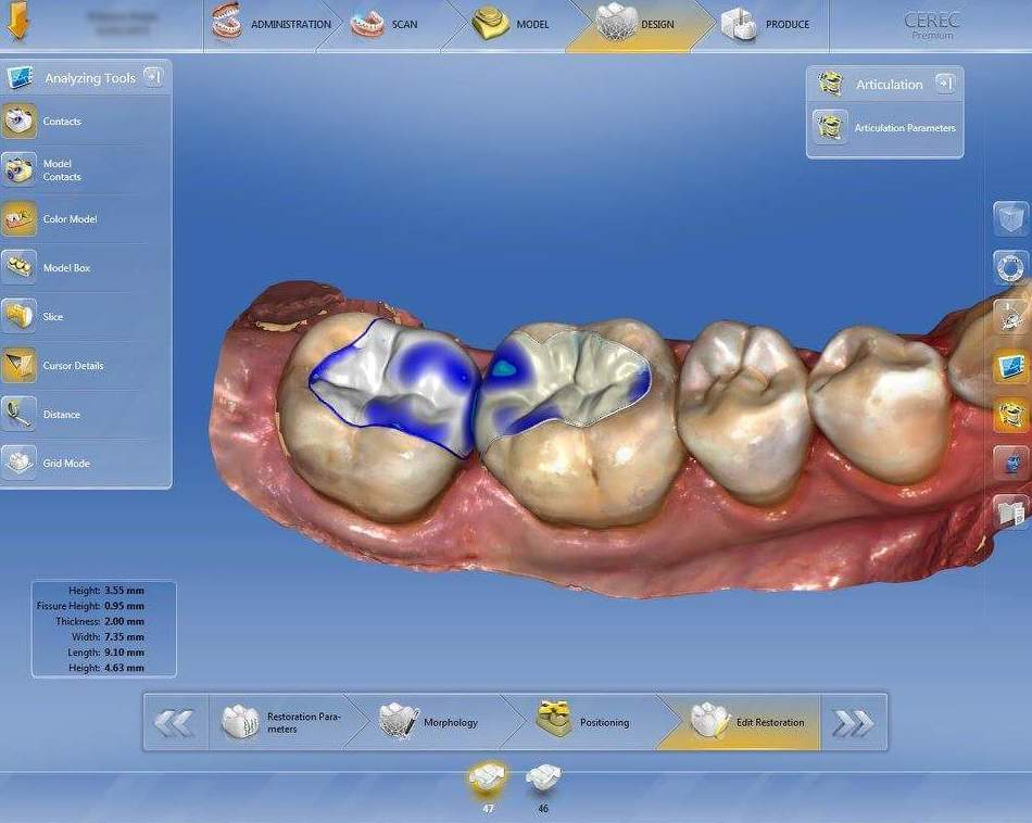 Tecnología CAD-CAM y Escaner intraoral TAC