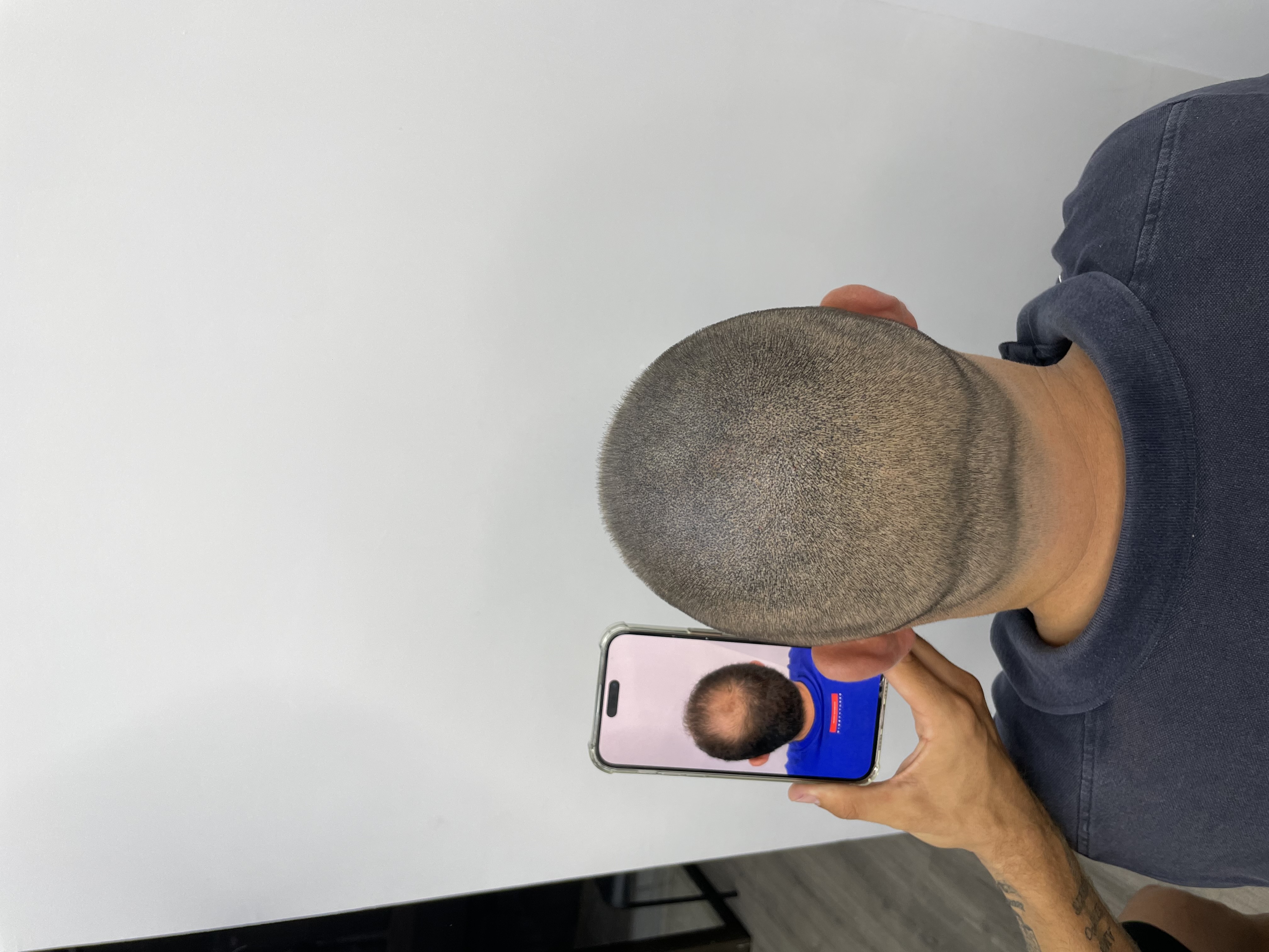 Hair Micropigmentation