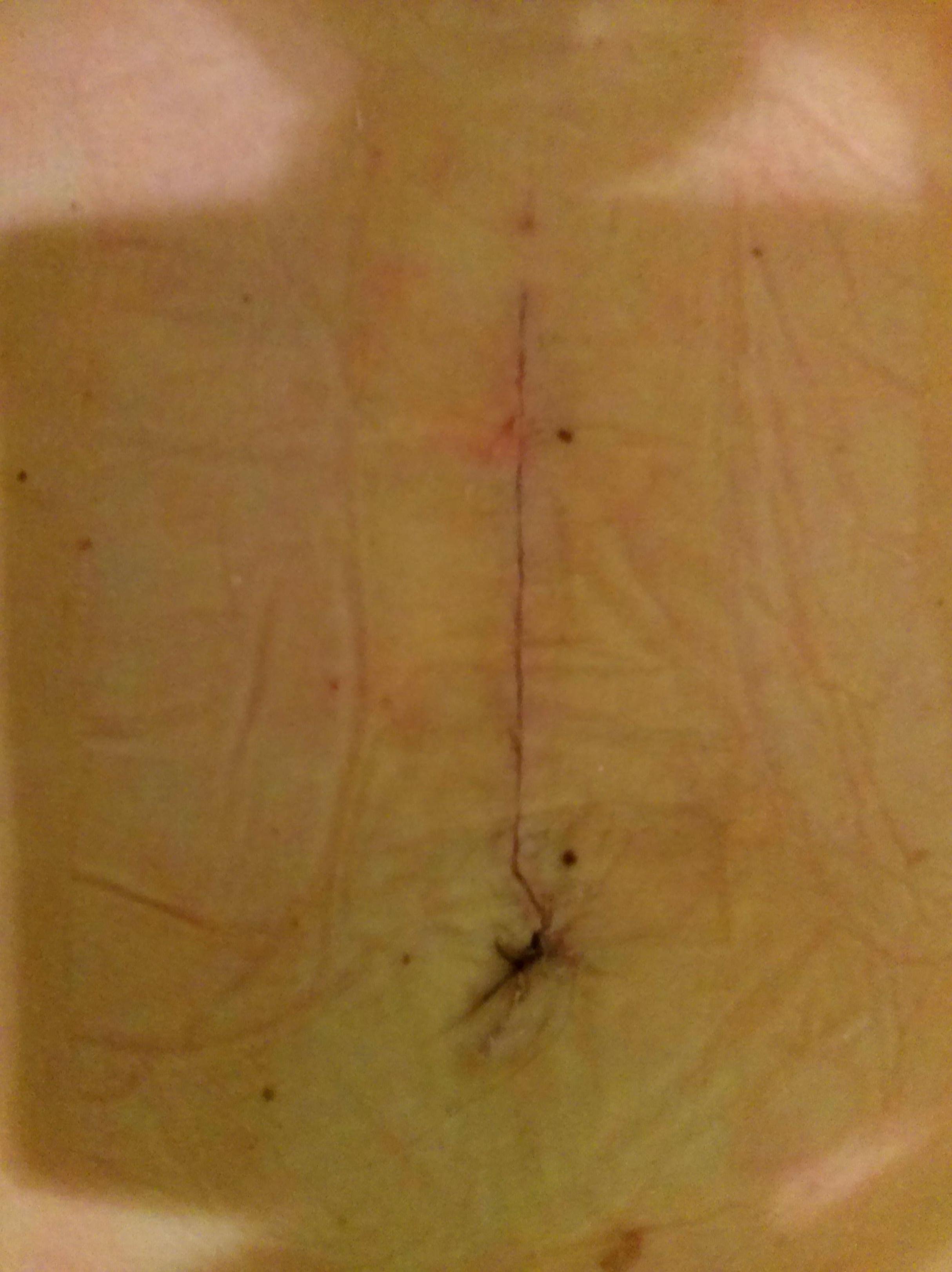 Cirugía de hernia abdominal