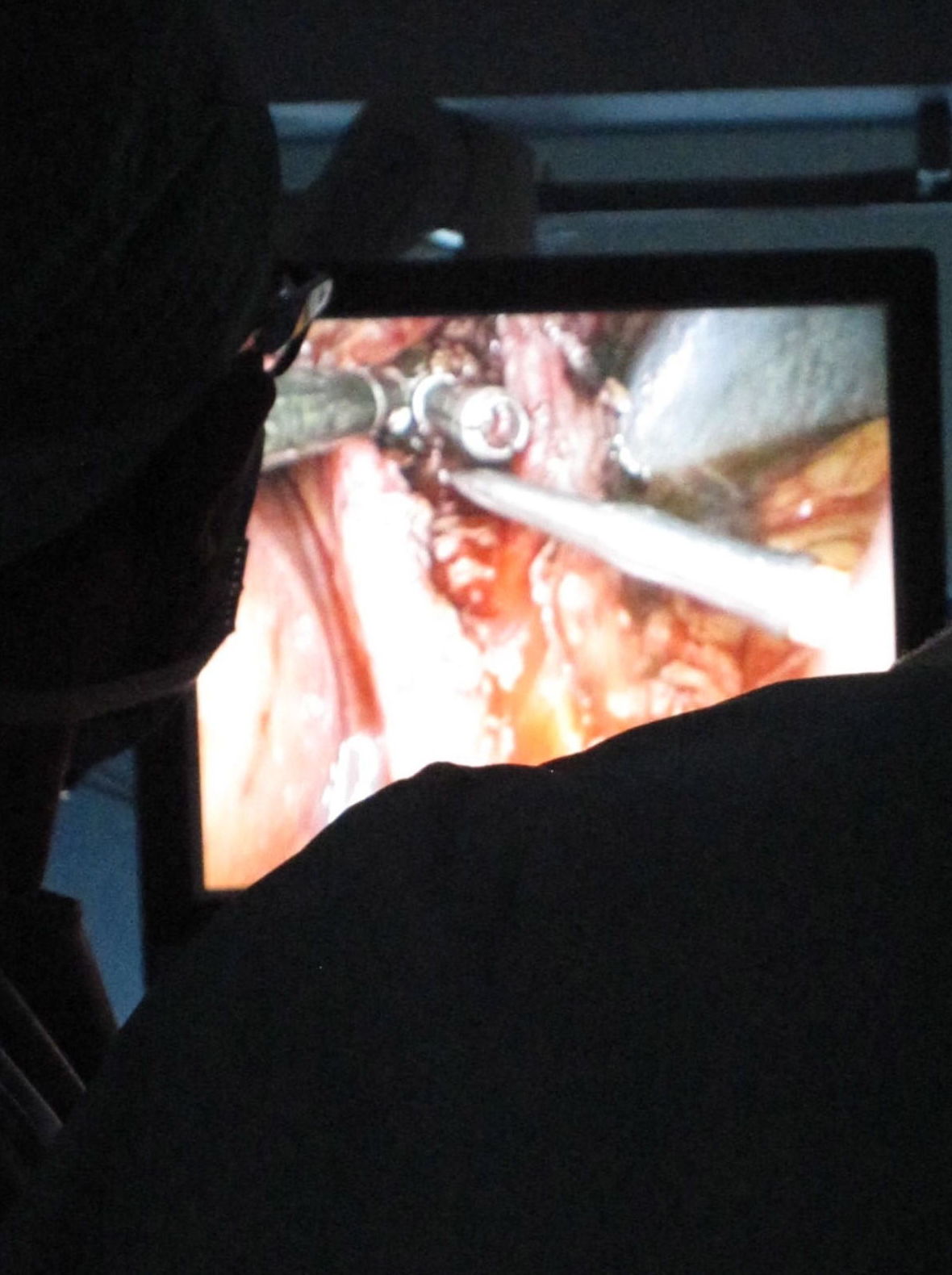 Absceso y fistula anal