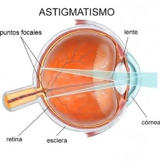 EL SENTIDO DE LA VISTA - ANOMALÍAS DE LA VISIÓN