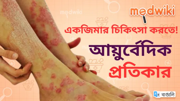 একজিমার চিকিৎসায় আয়ুর্বেদিক প্রতিকার!