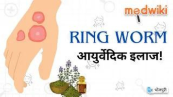 Ringworm & आयुर्वेद
