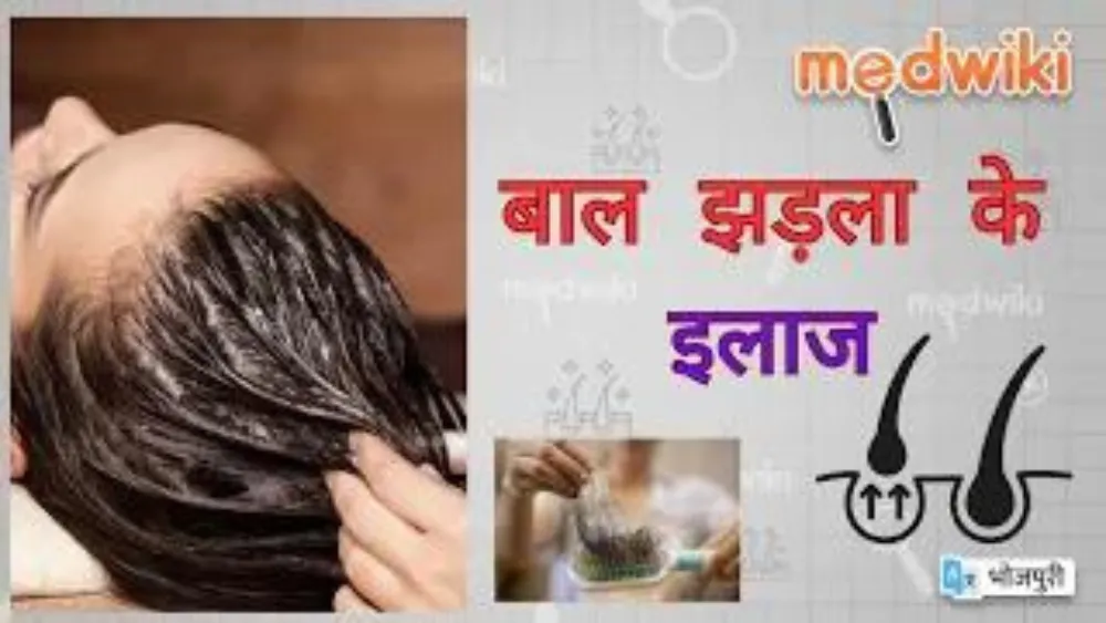 बाल झड़ला के इलाज ?