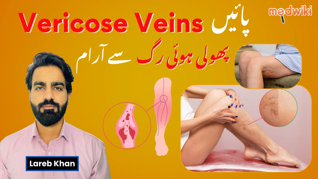 Varicose Veins کو مینیج کریں: سیلف کیئر اور میڈیکل طریقے!