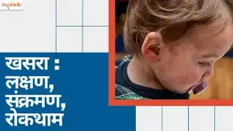 खसरा : लक्षण, संक्रमण, रोकथाम
