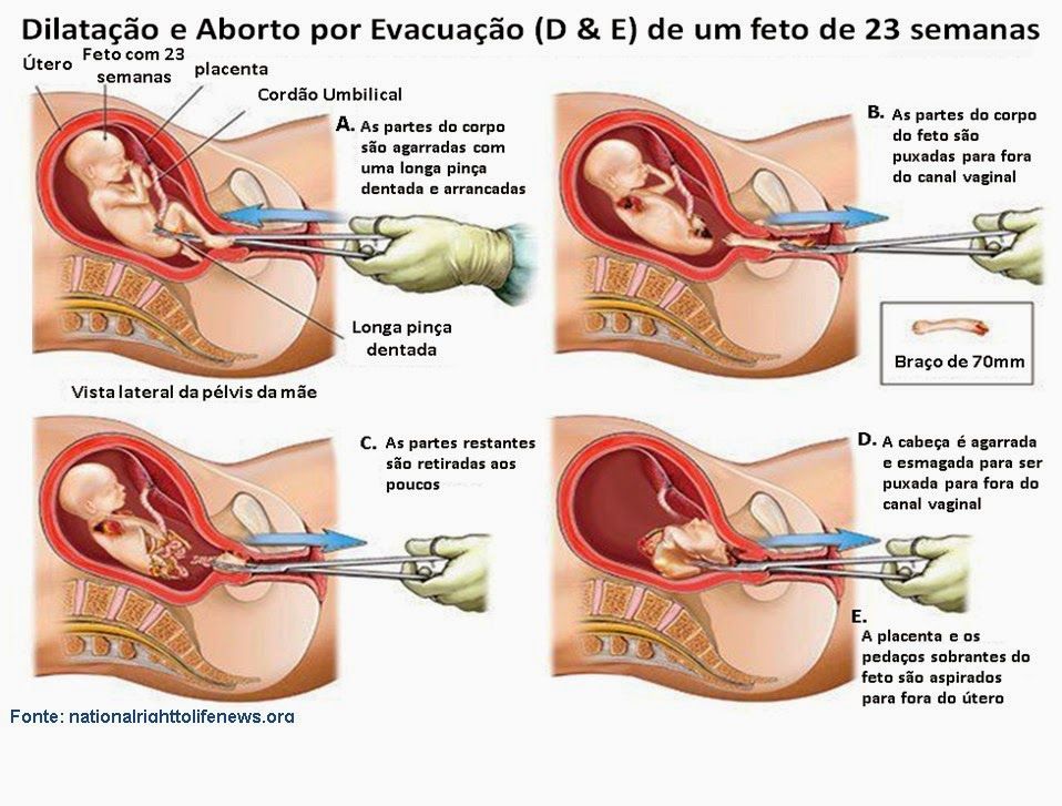 Aborto