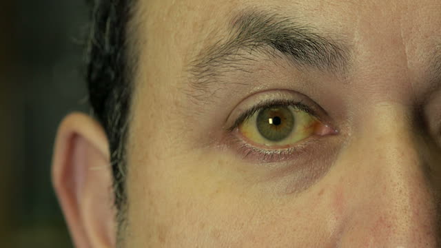 Ictericia