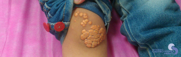 Xantoma