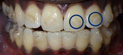 Light Blue Braces On Dark Skin