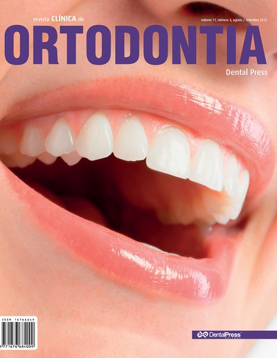 Montagem de aparelho ortodôntico lingual na arcada dentária superior pela Insubria System Lingual Technique