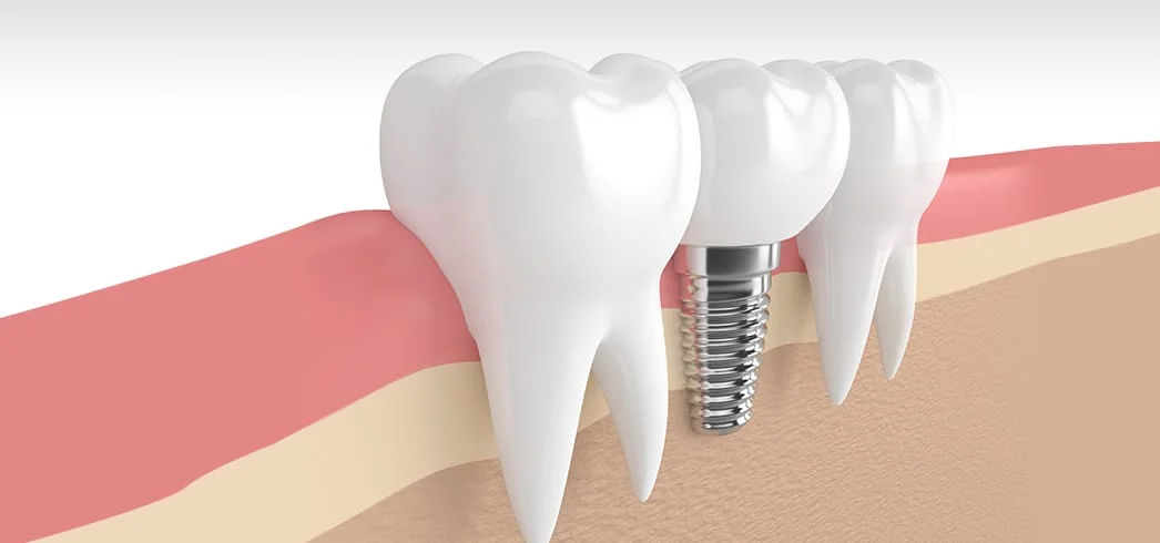 COSMETIC DENTISTRY LOS ALGODONES MEXICO