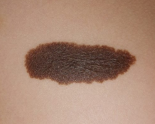 Melanoma