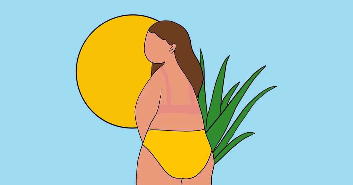 Laser away article image for A Comprehensive Guide to Treating Sunburns