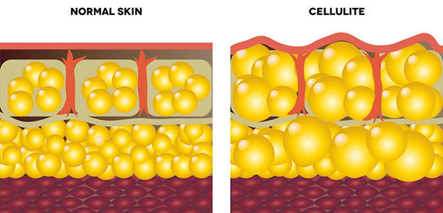 Laser away post image for 13 Surefire Cures for Cellulite