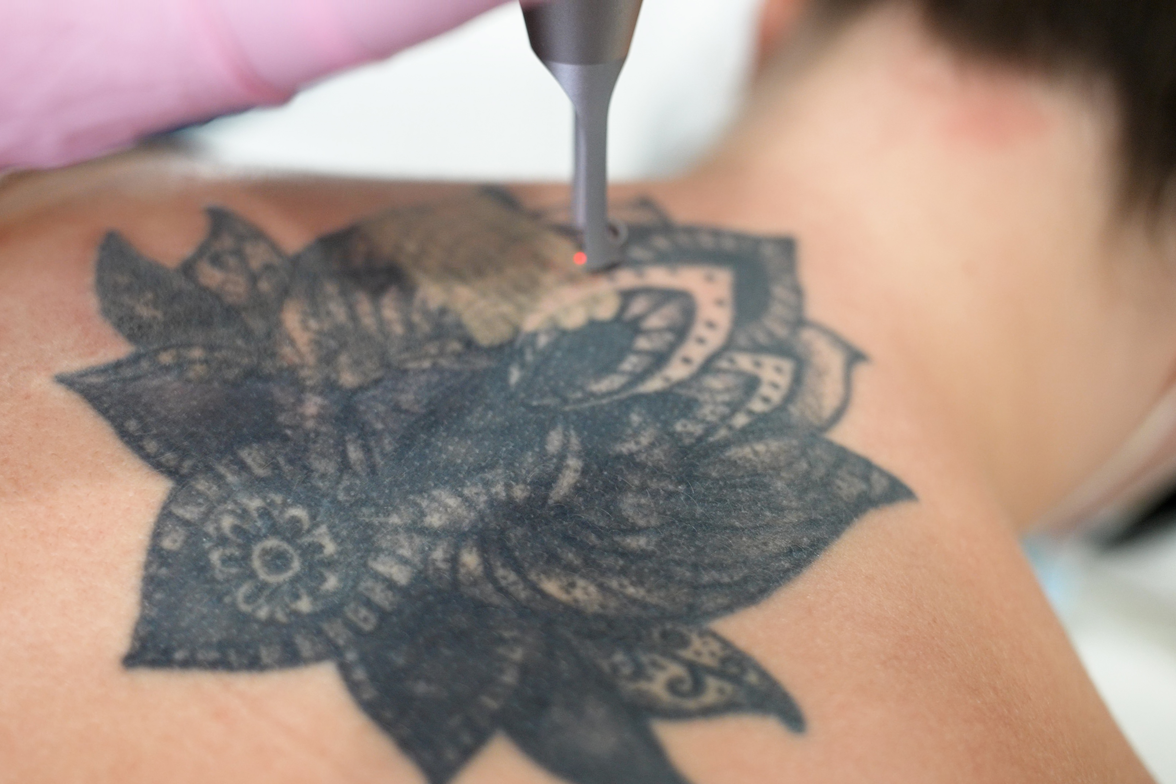 Laser Tattoo Removal