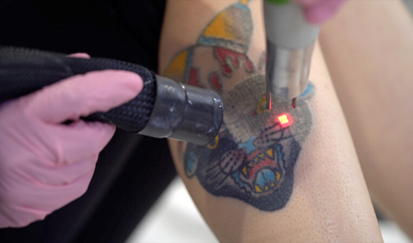 Laser away faq image for Which Colors Of Ink Are The Most Difficult To Remove?