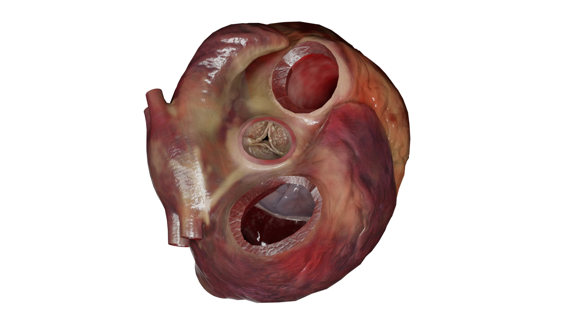 Stenosi della valvola aortica