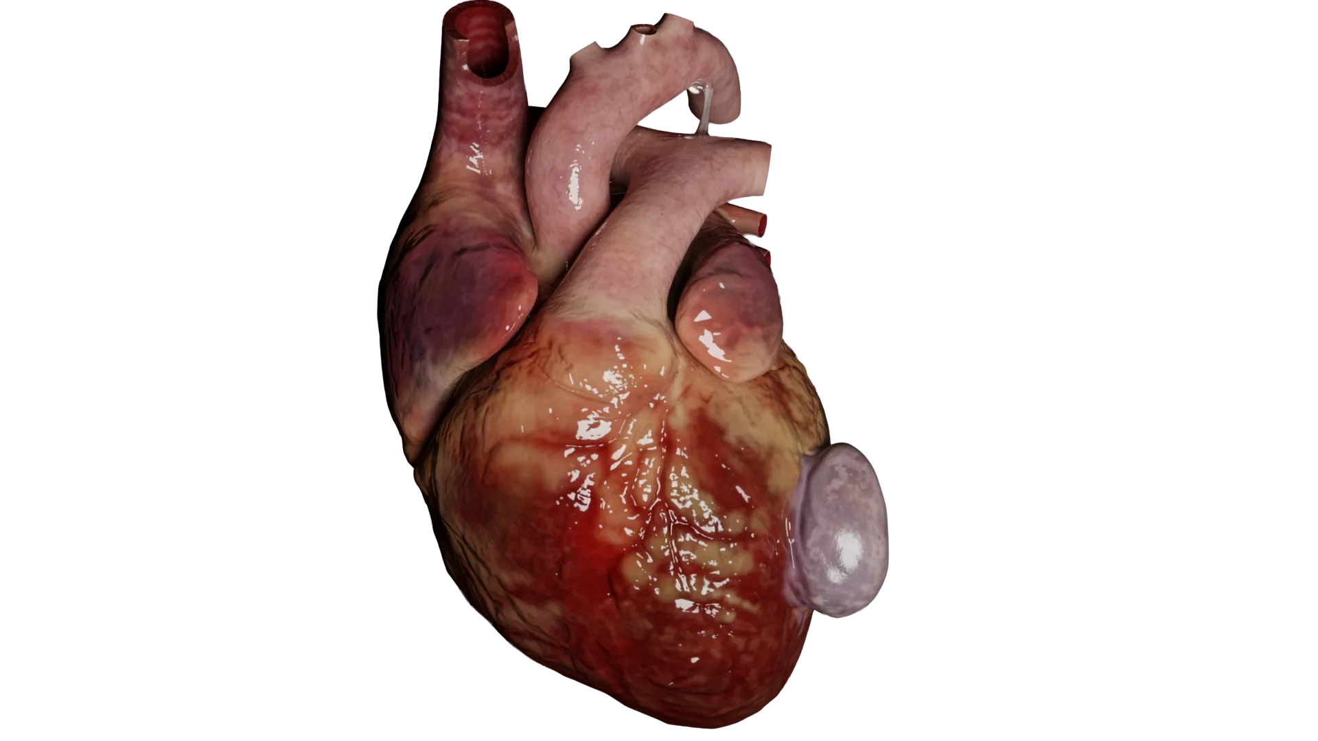 Pseudoaneurisma do ventrículo esquerdo pós-infarto