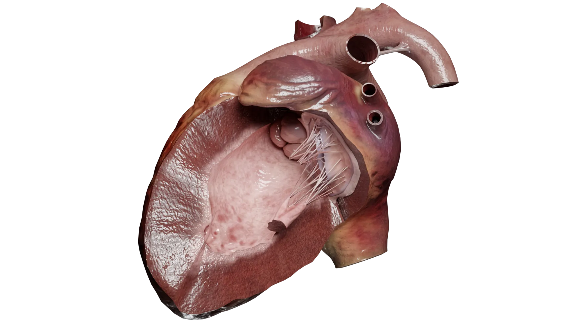 Cardiomiopatia restritiva