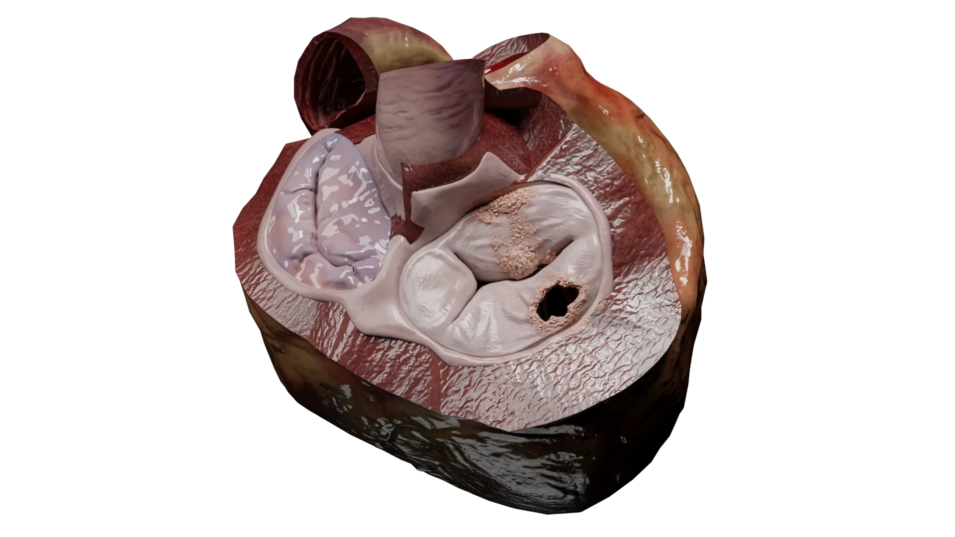 Endocardite infecciosa do lado direito