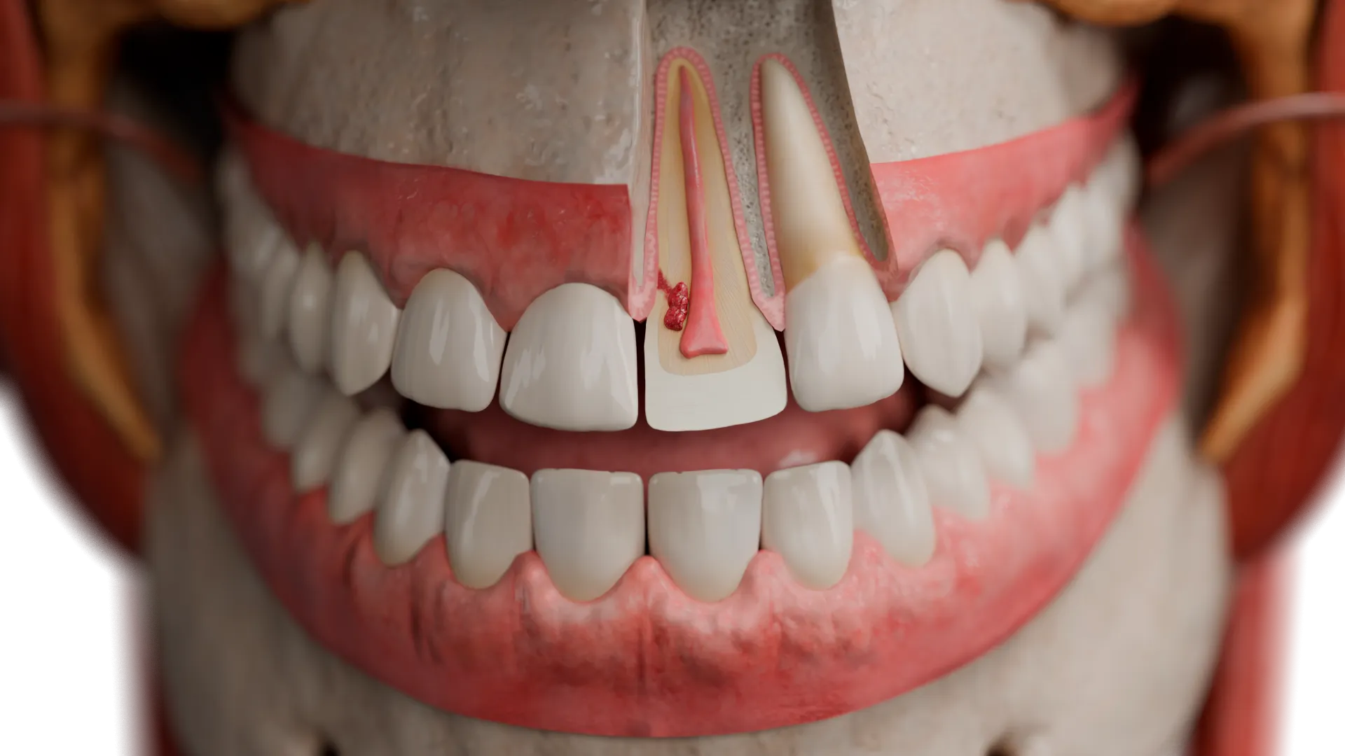 Cervicale esterna Classe 2 (collo del dente, vicino alla polpa)