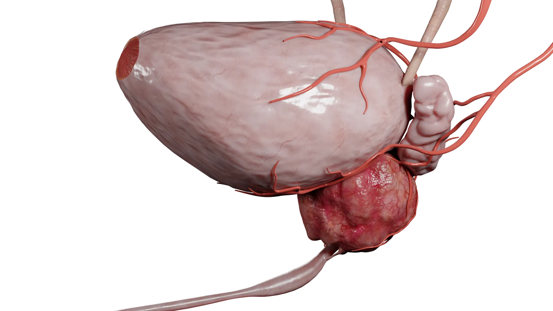 Острый простатит