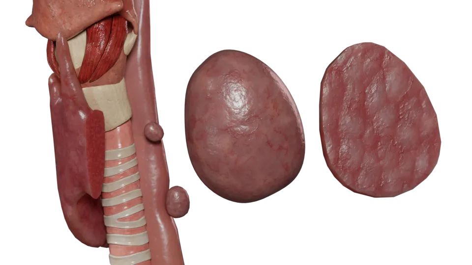 Secondaire (hyperplasie parathyroïdienne)