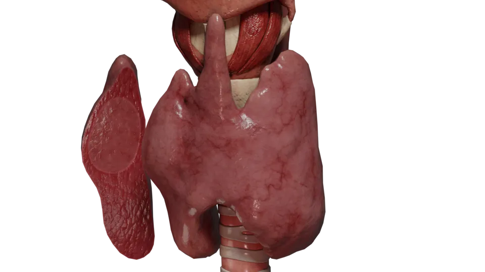 Adénome thyroïdien toxique