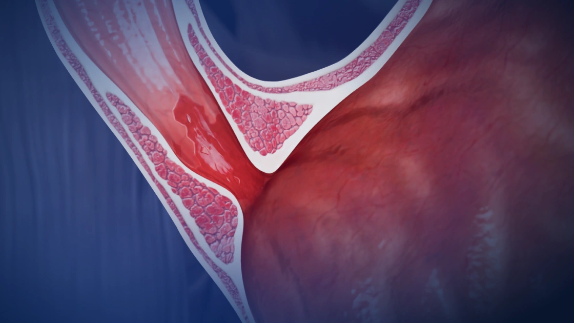 Barrett’s esophagus