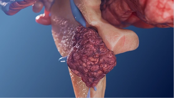 Эпендимома