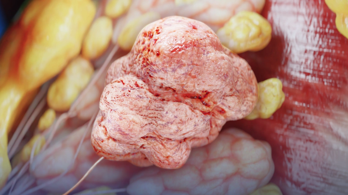 Высокоразвитая опухоль Фаллота